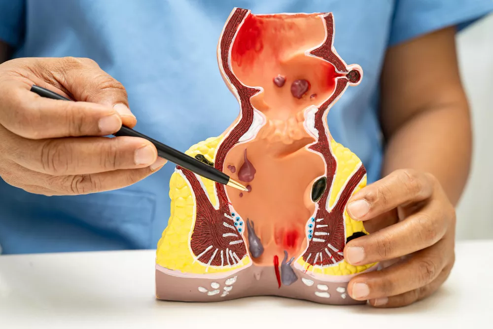 Piles, Fissure & Hemorrhoids Care